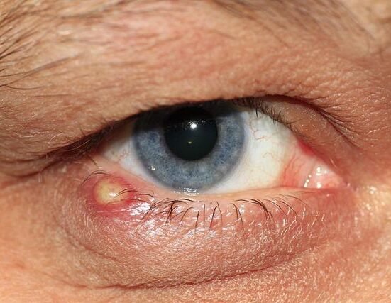 Signs of Chronic Inflammation