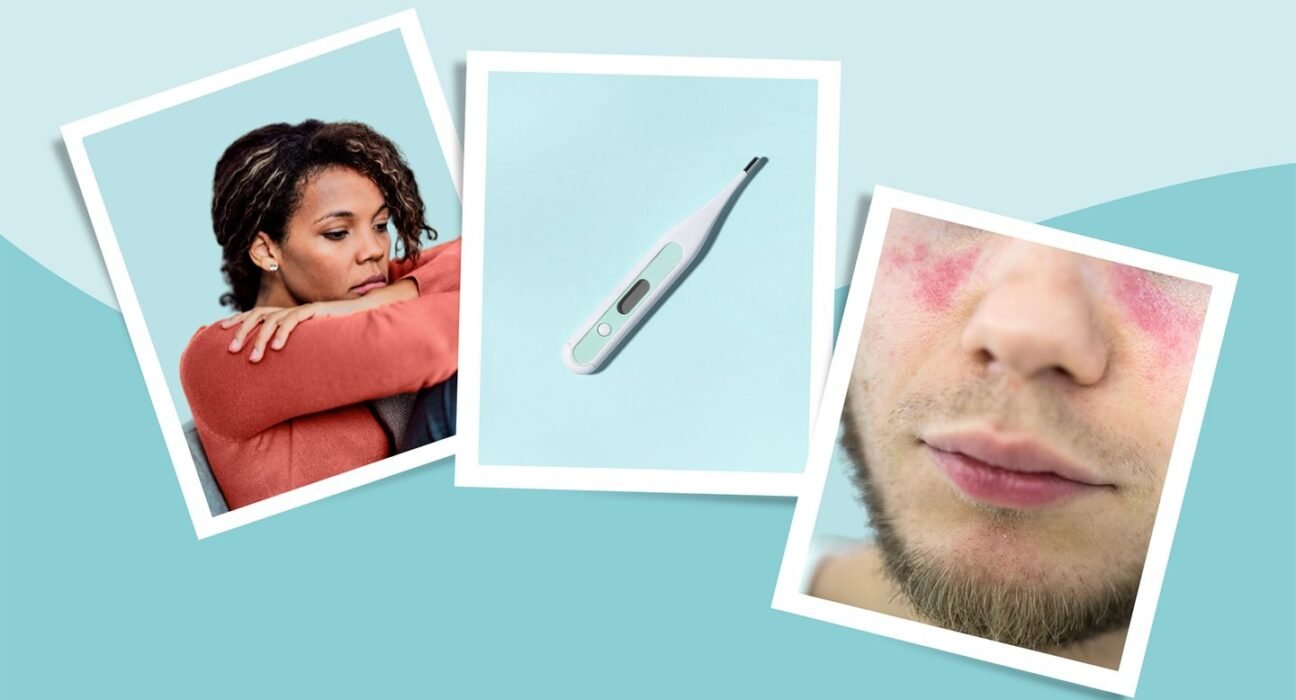Lupus Symptoms
