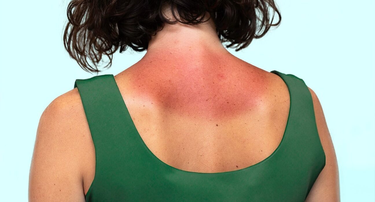 What Is Sun Poisoning? Plus, How to Treat and Prevent It