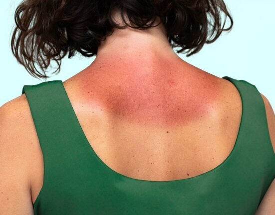 What Is Sun Poisoning? Plus, How to Treat and Prevent It